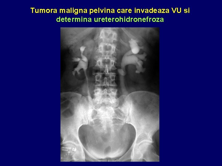Tumora maligna pelvina care invadeaza VU si determina ureterohidronefroza 