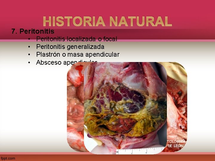 HISTORIA NATURAL 7. Peritonitis • • Peritonitis localizada o focal Peritonitis generalizada Plastrón o