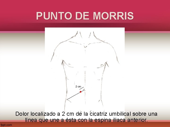 PUNTO DE MORRIS Dolor localizado a 2 cm de la cicatriz umbilical sobre una
