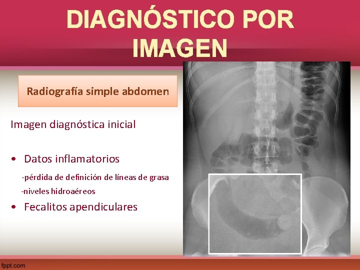 DIAGNÓSTICO POR IMAGEN Radiografía simple abdomen Imagen diagnóstica inicial • Datos inflamatorios -pérdida de