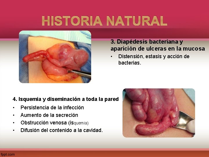 HISTORIA NATURAL 3. Diapédesis bacteriana y aparición de ulceras en la mucosa • Distensión,