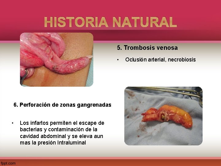 HISTORIA NATURAL 5. Trombosis venosa • 6. Perforación de zonas gangrenadas • Los infartos