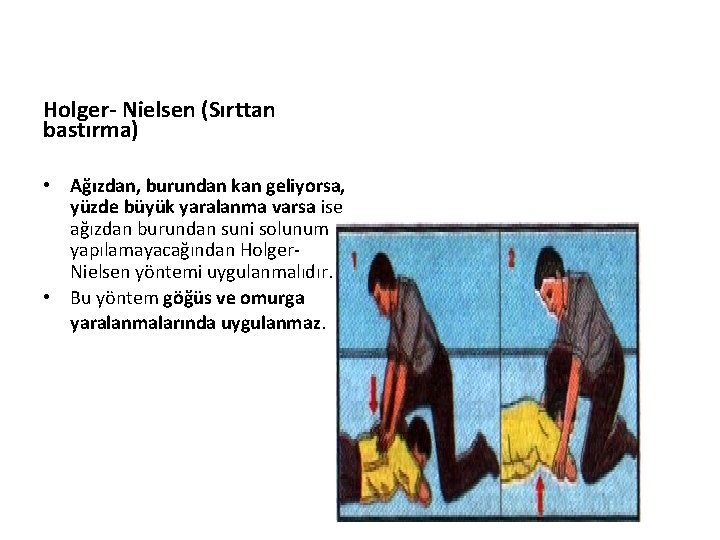 Holger- Nielsen (Sırttan bastırma) • Ağızdan, burundan kan geliyorsa, yüzde büyük yaralanma varsa ise