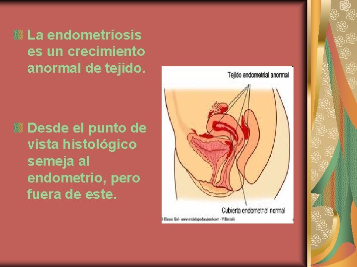 La endometriosis es un crecimiento anormal de tejido. Desde el punto de vista histológico
