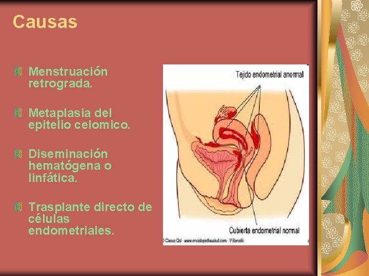 Causas Menstruación retrograda. Metaplasia del epitelio celomico. Diseminación hematógena o linfática. Trasplante directo de