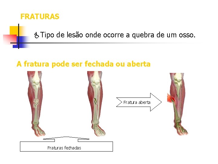 FRATURAS Tipo de lesão onde ocorre a quebra de um osso. A fratura pode