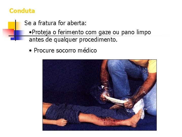 Conduta Se a fratura for aberta: • Proteja o ferimento com gaze ou pano