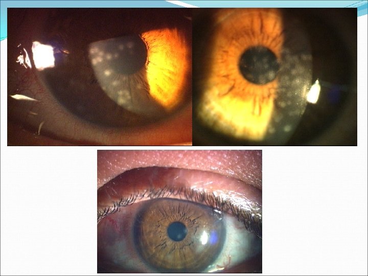 VİRAL KONJONKTİVİT 