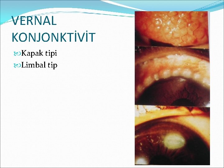 VERNAL KONJONKTİVİT Kapak tipi Limbal tip 