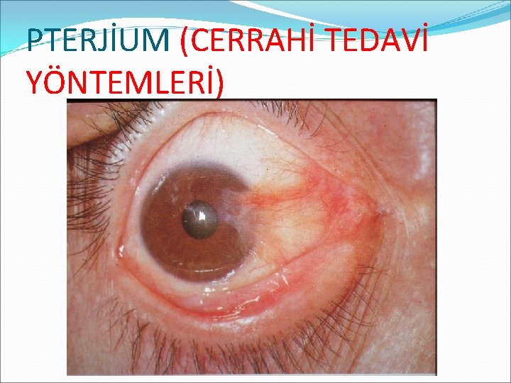 PTERJİUM (CERRAHİ TEDAVİ YÖNTEMLERİ) 