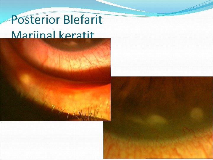 Posterior Blefarit Marjinal keratit 