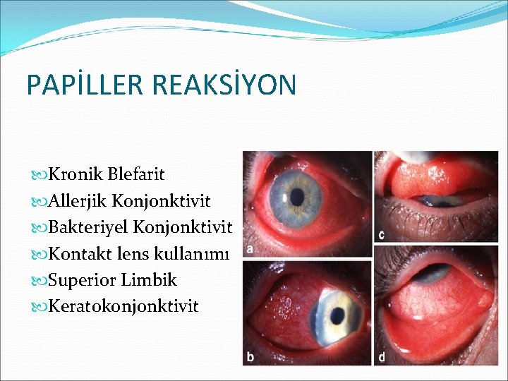 PAPİLLER REAKSİYON Kronik Blefarit Allerjik Konjonktivit Bakteriyel Konjonktivit Kontakt lens kullanımı Superior Limbik Keratokonjonktivit