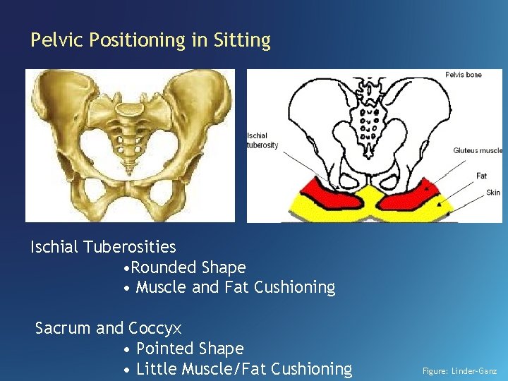 Pelvic Positioning in Sitting Ischial Tuberosities • Rounded Shape • Muscle and Fat Cushioning