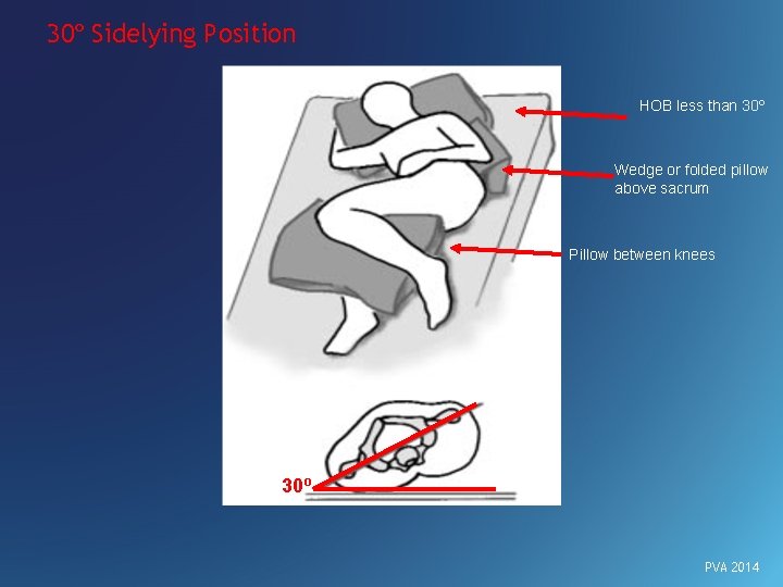 30º Sidelying Position HOB less than 30º Wedge or folded pillow above sacrum Pillow