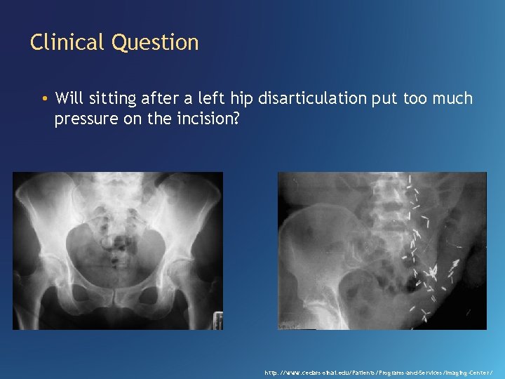 Clinical Question • Will sitting after a left hip disarticulation put too much pressure