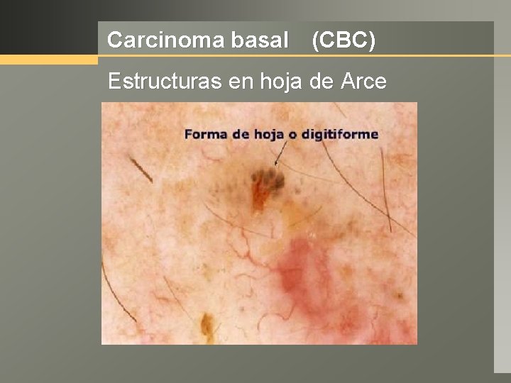 Carcinoma basal (CBC) Estructuras en hoja de Arce 