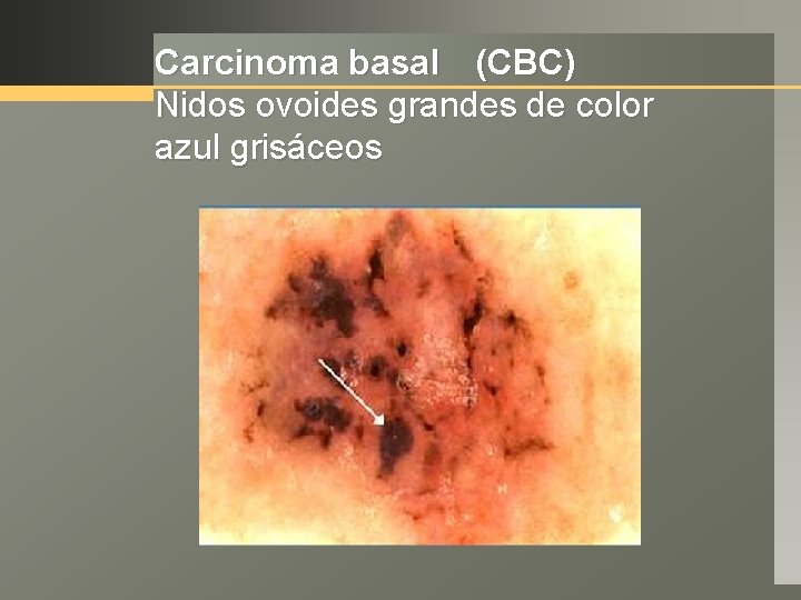 Carcinoma basal (CBC) Nidos ovoides grandes de color azul grisáceos 