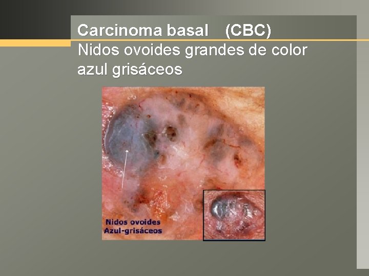 Carcinoma basal (CBC) Nidos ovoides grandes de color azul grisáceos 