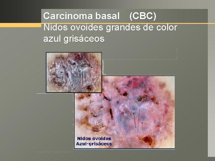 Carcinoma basal (CBC) Nidos ovoides grandes de color azul grisáceos 