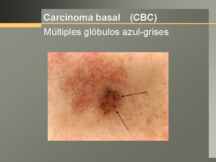 Carcinoma basal (CBC) Múltiples glóbulos azul-grises 