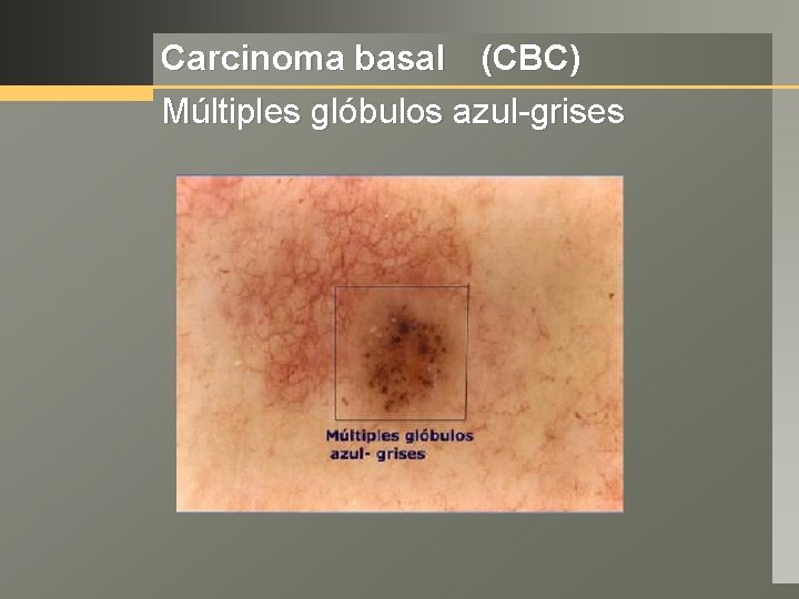 Carcinoma basal (CBC) Múltiples glóbulos azul-grises 