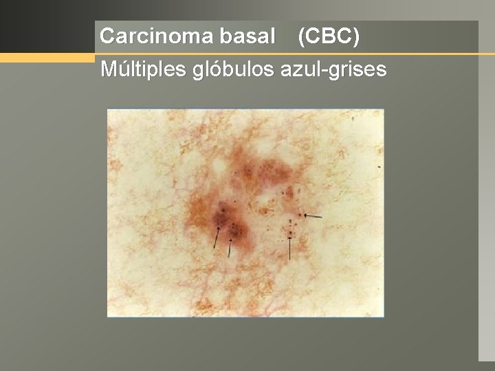 Carcinoma basal (CBC) Múltiples glóbulos azul-grises 