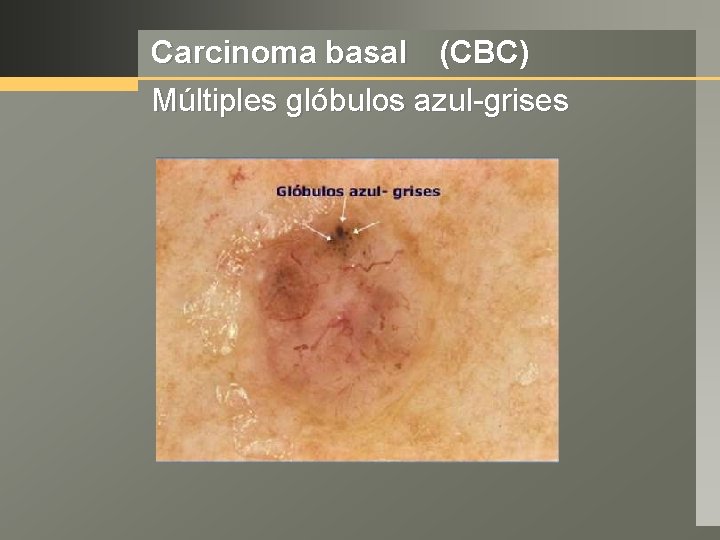 Carcinoma basal (CBC) Múltiples glóbulos azul-grises 