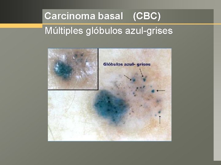 Carcinoma basal (CBC) Múltiples glóbulos azul-grises 