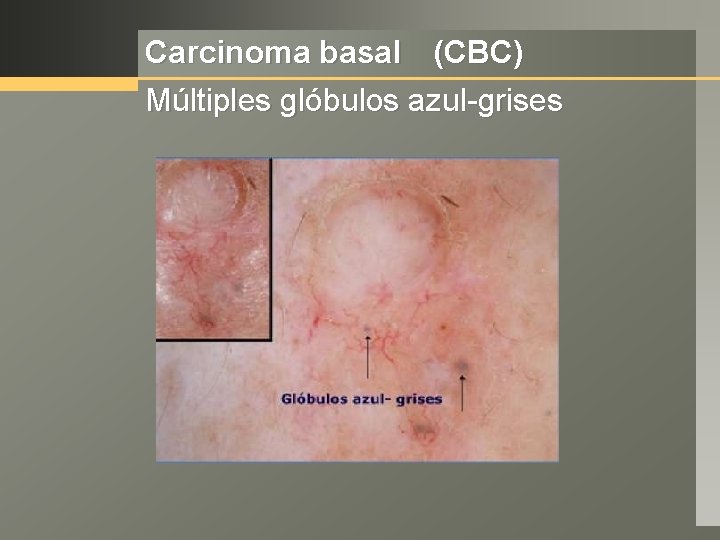 Carcinoma basal (CBC) Múltiples glóbulos azul-grises 