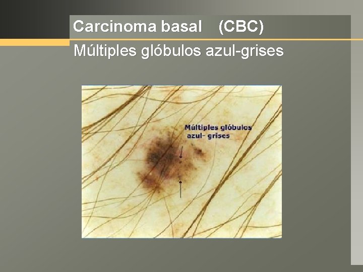Carcinoma basal (CBC) Múltiples glóbulos azul-grises 