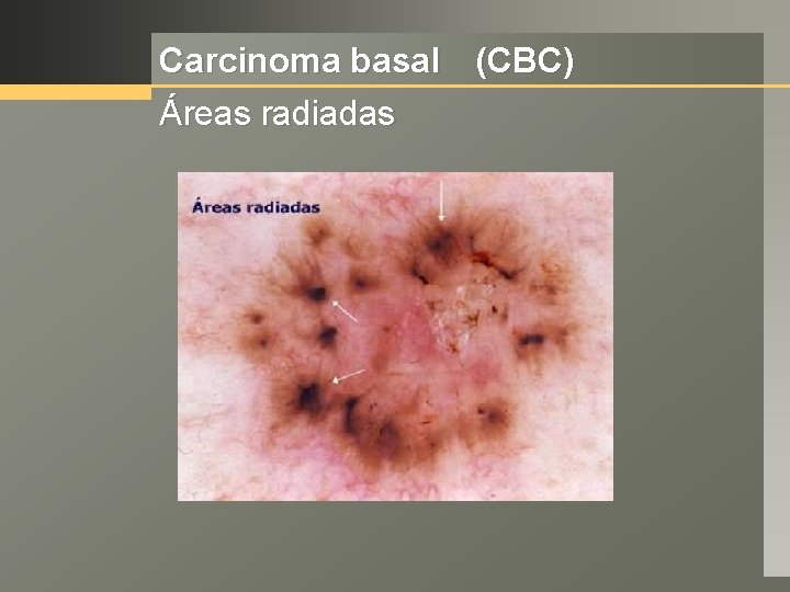 Carcinoma basal (CBC) Áreas radiadas 