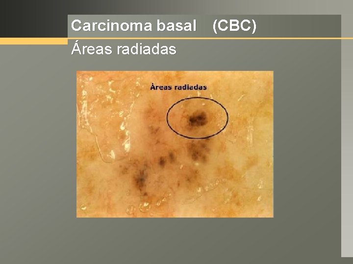 Carcinoma basal (CBC) Áreas radiadas 