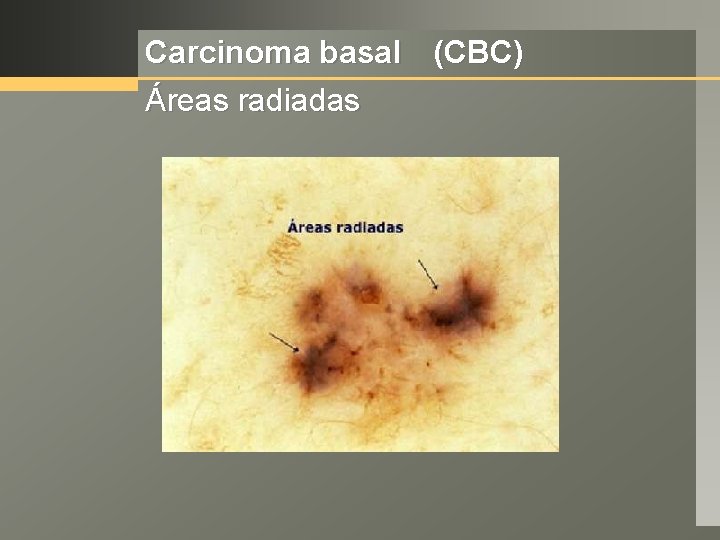 Carcinoma basal (CBC) Áreas radiadas 