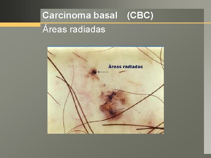 Carcinoma basal (CBC) Áreas radiadas 