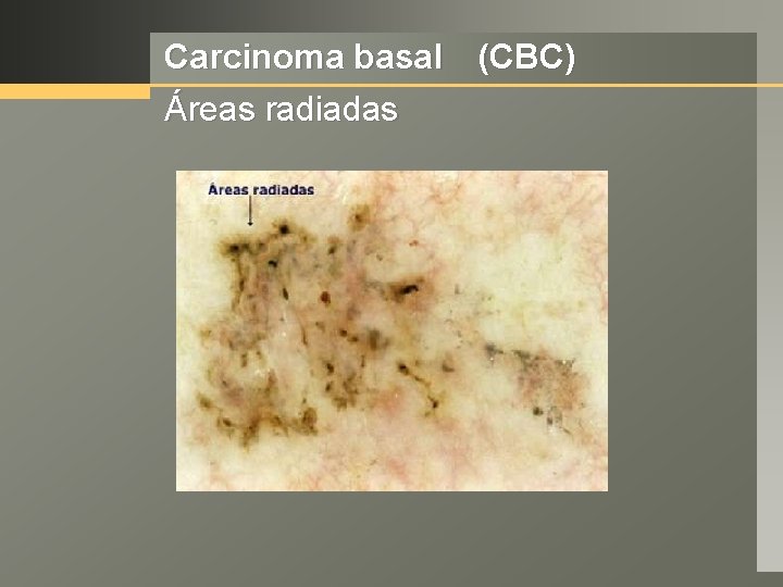 Carcinoma basal (CBC) Áreas radiadas 