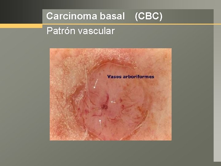 Carcinoma basal (CBC) Patrón vascular 