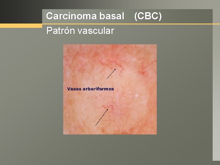 Carcinoma basal (CBC) Patrón vascular 