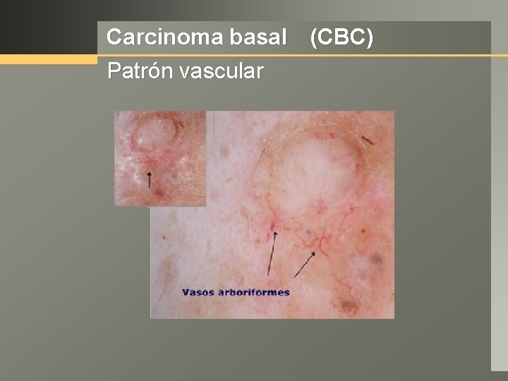 Carcinoma basal (CBC) Patrón vascular 