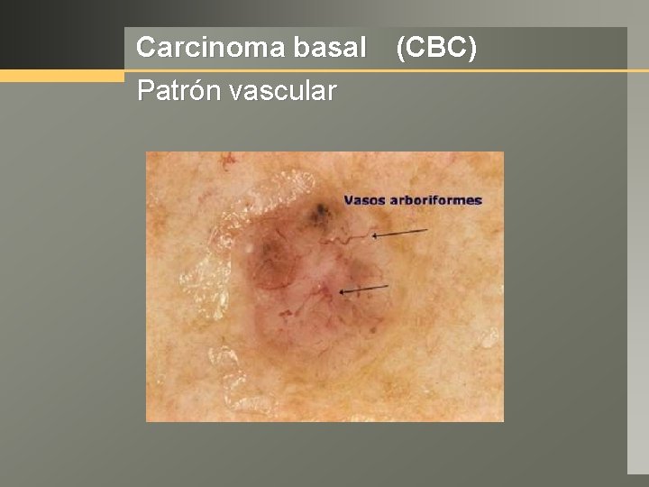 Carcinoma basal (CBC) Patrón vascular 