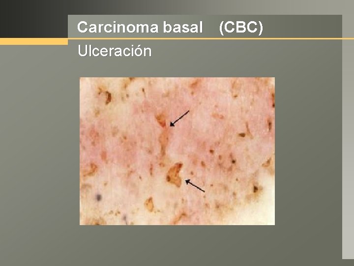 Carcinoma basal (CBC) Ulceración 