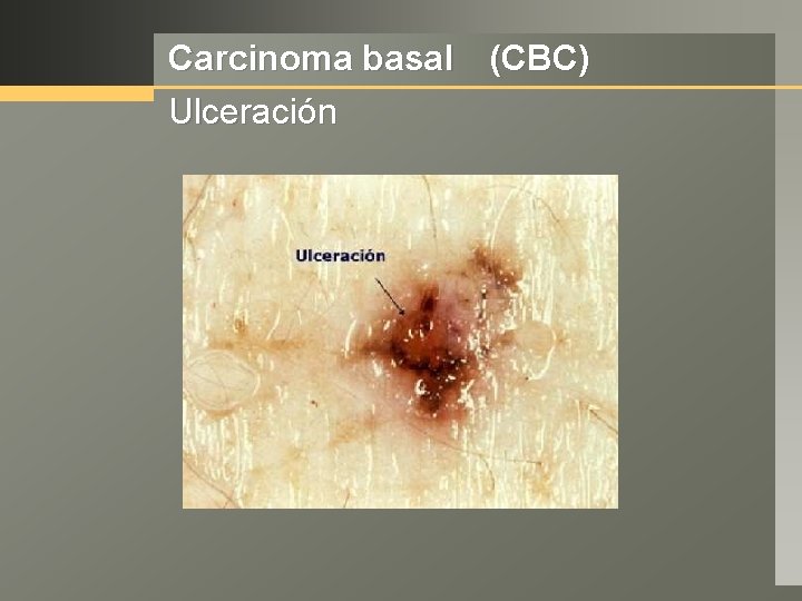Carcinoma basal (CBC) Ulceración 