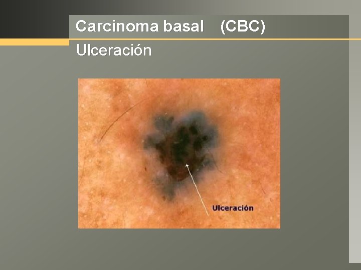 Carcinoma basal (CBC) Ulceración 