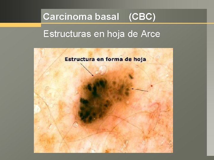 Carcinoma basal (CBC) Estructuras en hoja de Arce 