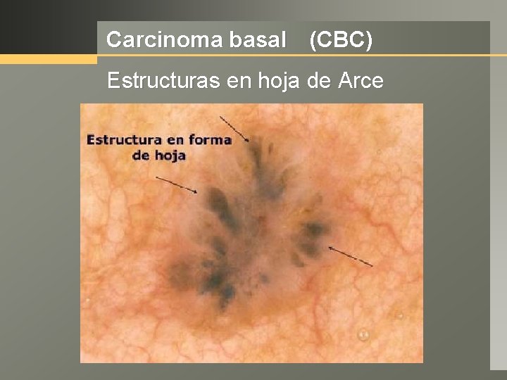 Carcinoma basal (CBC) Estructuras en hoja de Arce 