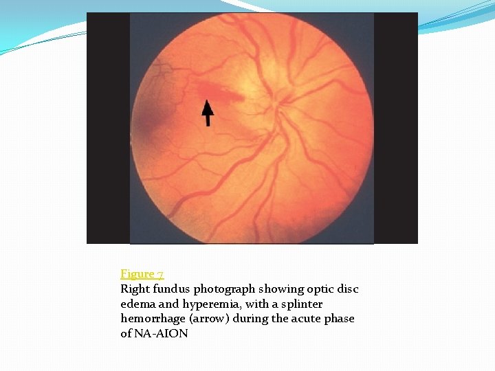 Figure 7 Right fundus photograph showing optic disc edema and hyperemia, with a splinter