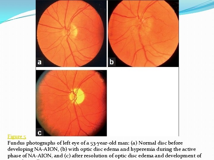 Figure 5 Fundus photographs of left eye of a 53 -year-old man: (a) Normal