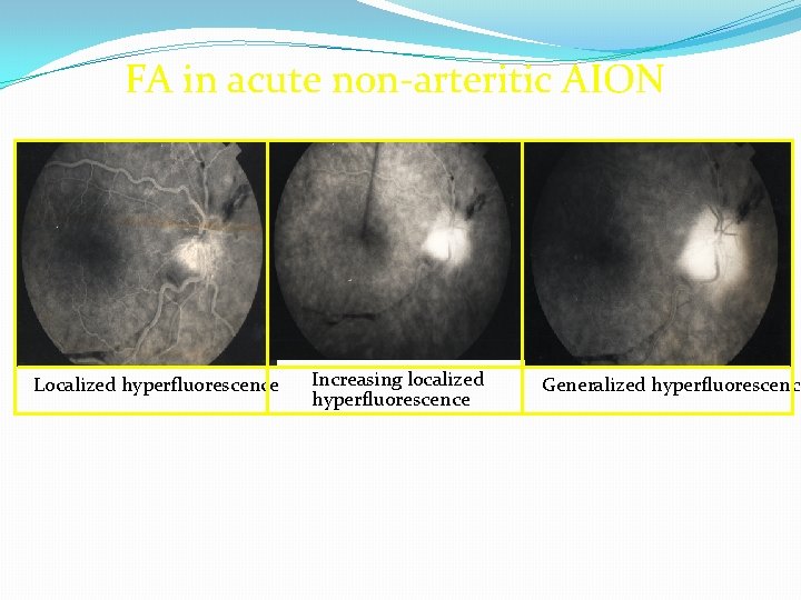 FA in acute non-arteritic AION Localized hyperfluorescence Increasing localized hyperfluorescence Generalized hyperfluorescence 