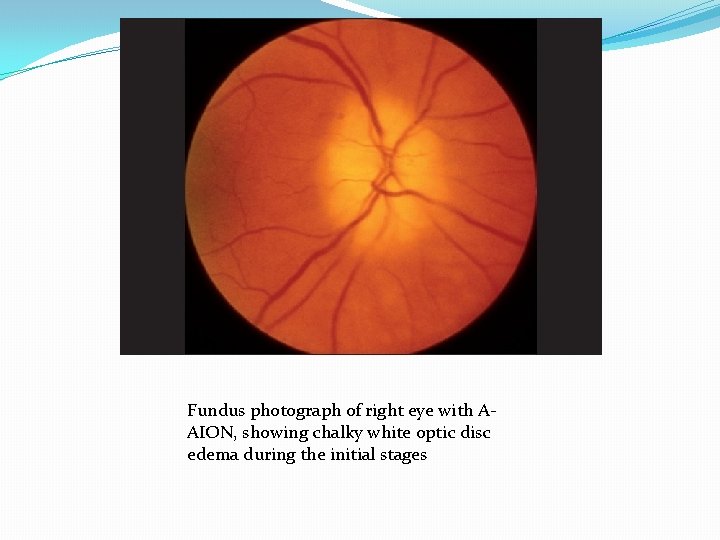 Fundus photograph of right eye with AAION, showing chalky white optic disc edema during