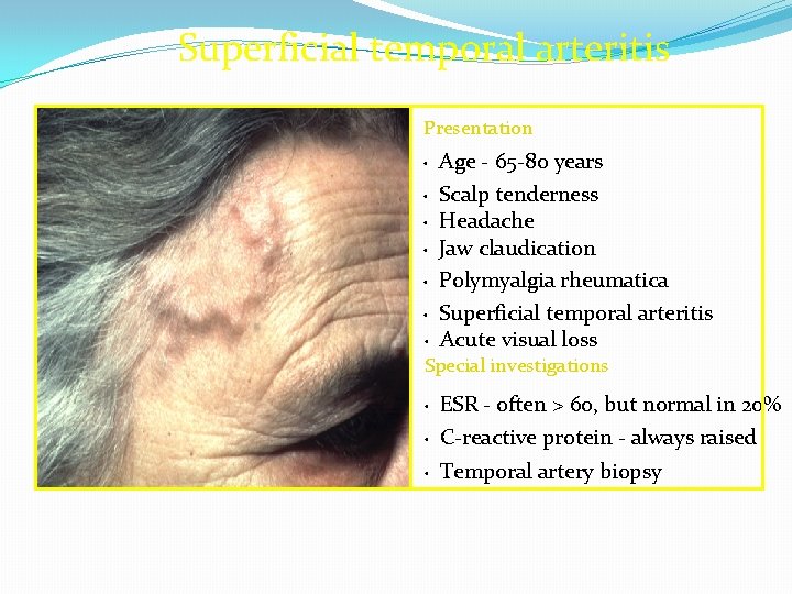 Superficial temporal arteritis Presentation Age - 65 -80 years • Scalp tenderness • Headache