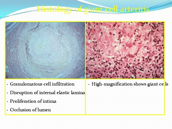 Histology of giant cell arteritis Granulomatous cell infiltration • Disruption of internal elastic lamina